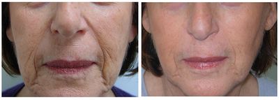 trattamento al viso prima e dopo