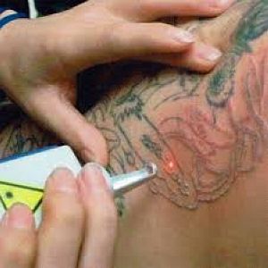 laser per rimozione tatuaggi